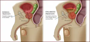 Reproductive Prints: Comparison of Normal and Enlarged Prostate