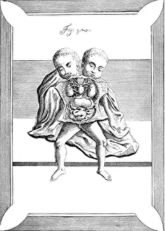 Twins Prints: Conjoined Twins, 18th Century