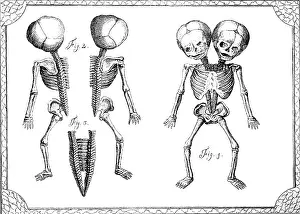 Twins Prints: Conjoined Twins, 18th Century
