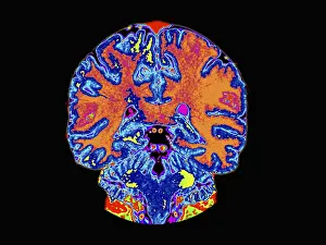 Magnetic Prints: Coronal View MRI of Normal Brain
