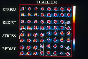 Nuclear Prints: Coronary Heart Disease