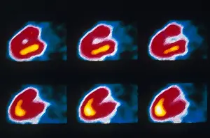 Nuclear Prints: Coronary Heart Disease