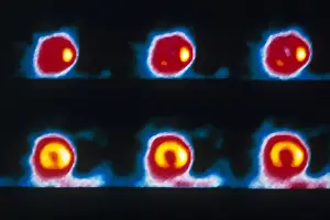 Nuclear Prints: Coronary Heart Disease