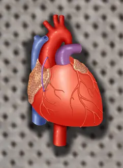 Circulation Prints: Coronary Vein Graft