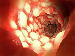 Many Science & Medical Prints: Crohn's disease, artwork
