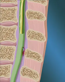 Cord Prints: CSF Leak in the Spinal Cord