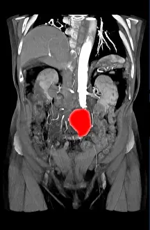 Aortic Prints: CT Scan of Abdominal Aortic Aneurysm
