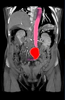 Aortic Prints: CT Scan of Abdominal Aortic Aneurysm