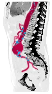 Aortic Prints: CT Scan of Abdominal Aortic Aneurysm