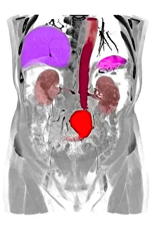 Aortic Prints: CT Scan of Abdominal Aortic Aneurysm