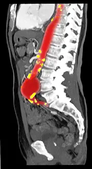 Aortic Prints: CT Scan of Abdominal Aortic Aneurysm