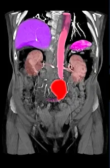 Aortic Prints: CT Scan of Abdominal Aortic Aneurysm