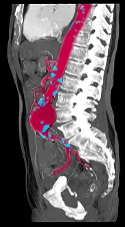 Abnormal Prints: CT Scan of Abdominal Aortic Aneurysm
