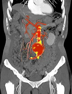 Abnormal Prints: CT Scan of Abdominal Aortic Aneurysm