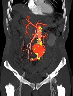 Abnormal Prints: CT Scan of Abdominal Aortic Aneurysm