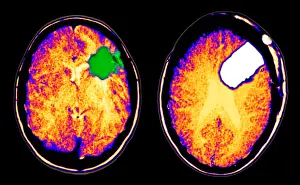 Neurosurgery Prints: CT scan of brain glioma and tumor removal