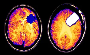 Tumor Prints: CT scan of brain glioma and tumor removal