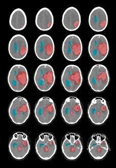 Brain Prints: CT Scan of Intracranial Hemorrhage