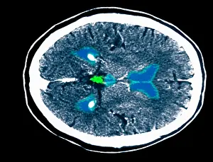 Medical Prints: CT scan of a normal brain
