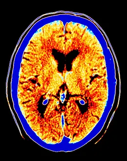 Medical Prints: CT scan of section through healthy brain