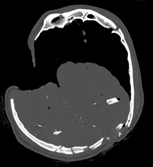 Medical Prints: CT Section, Gunshot Wound