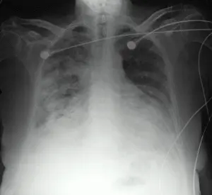 Condition Prints: CXR congestive heart failure 77 year old woman