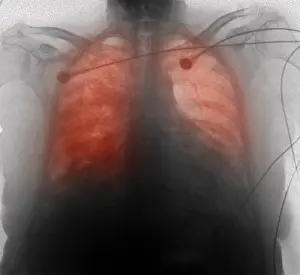 Condition Prints: CXR congestive heart failure 77 year old woman