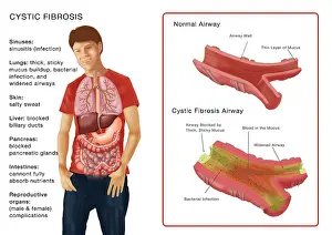 Recessive Prints: Cystic Fibrosis