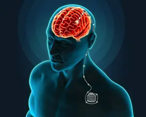 Neurological Prints: Deep Brain Stimulation, Illustration