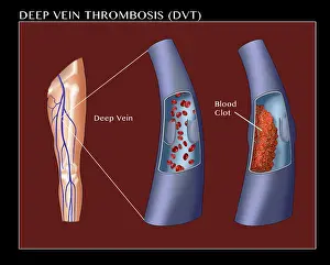 Clots Prints: Deep Vein Thrombosis, thrombophlebitis caused by a blood clot in the leg