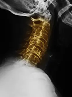 Condition Prints: Degenerative Arthritis
