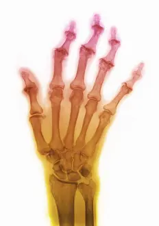 Hand Prints: Degenerative Arthritis