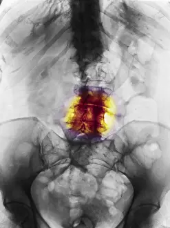 Back Prints: Degenerative Arthritis