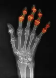 Hand Prints: Degenerative Arthritis
