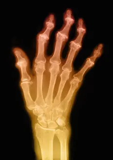 Hand Prints: Degenerative Arthritis