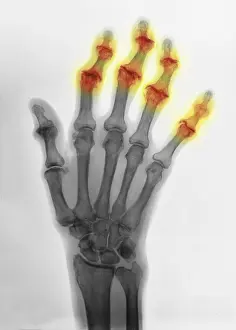 Diagnosis Prints: Degenerative Arthritis