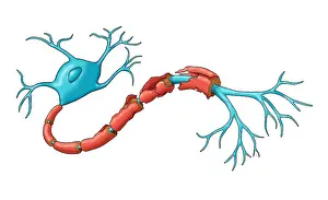 Demyelination Prints: Demyelination
