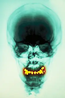 Filling Prints: Dental fillings