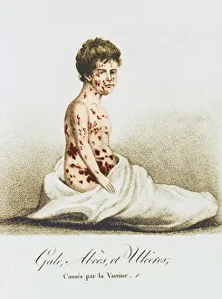 Patient Prints: Development of Smallpox after Vaccination, 1807