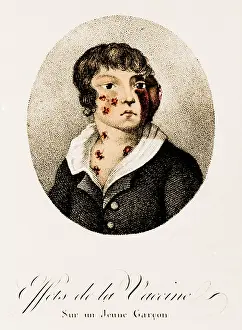 Development Prints: Development of Smallpox after Vaccination, 1807