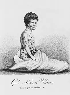 More Science & Medical Prints: Development of Smallpox after Vaccination, 1807