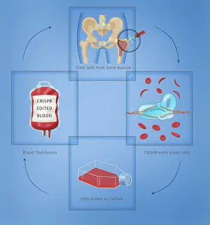 Flask Prints: Diagram of CRISPR gene therapy as a Sickle Cell Anemia Disease cure through a transfusion