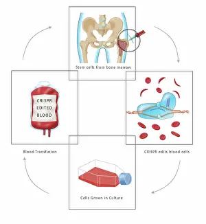 Flask Prints: Diagram of CRISPR gene therapy as a Sickle Cell Anemia Disease cure through a transfusion