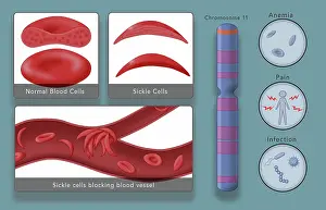 Mutation Prints: Diagram of Sickle Cell Anemia Disease