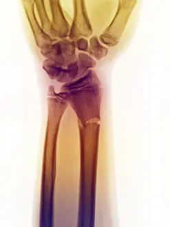 Year Prints: Distal Radius Fracture in a 14 Year Old Boy