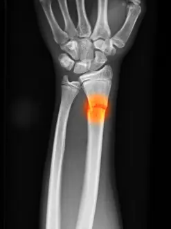 Year Prints: Distal Radius Fracture in a 14 Year Old Boy