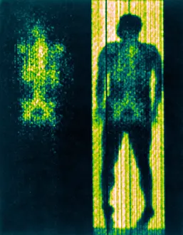 Radioactive Prints: Distribution of Red-Cell-Forming Tissue