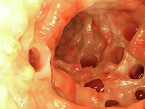 Pathological Prints: Diverticula in colon, artwork