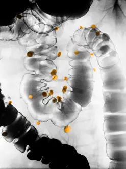 Intestines Prints: Diverticulosis