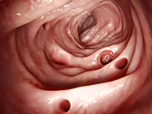 Pathological Prints: Diverticulosis